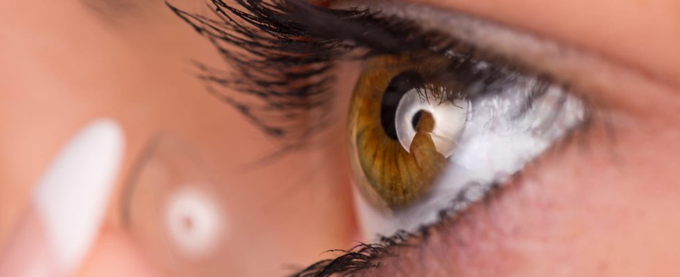 Keratoconus stage definition what treatments