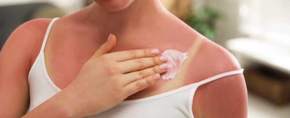 These creams soothe the fire of sunburn instantly