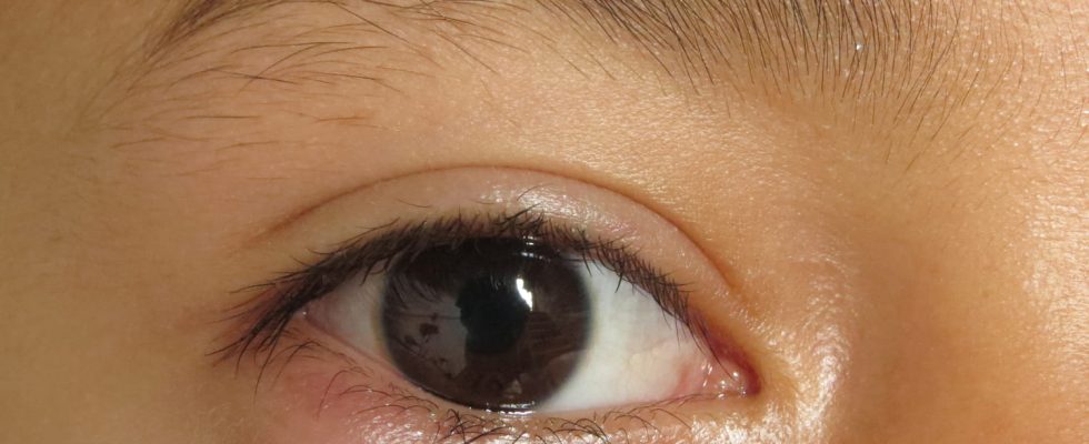 What is eye cellulite Signs and treatment