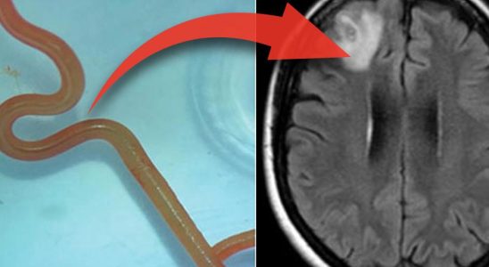 Doctors found live roundworm in womans brain