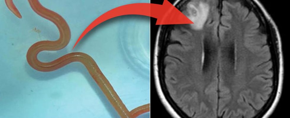 Doctors found live roundworm in womans brain