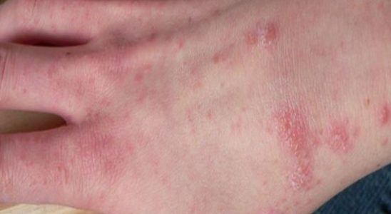 Nivel number of cases of scabies remains high