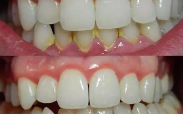 No more dental tartar and stones The most effective way