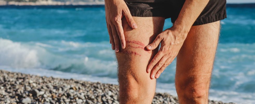 What to do immediately in case of a jellyfish sting