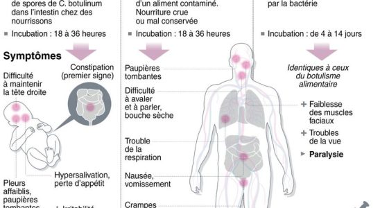 Case of botulism in Bordeaux the origin of this neurological