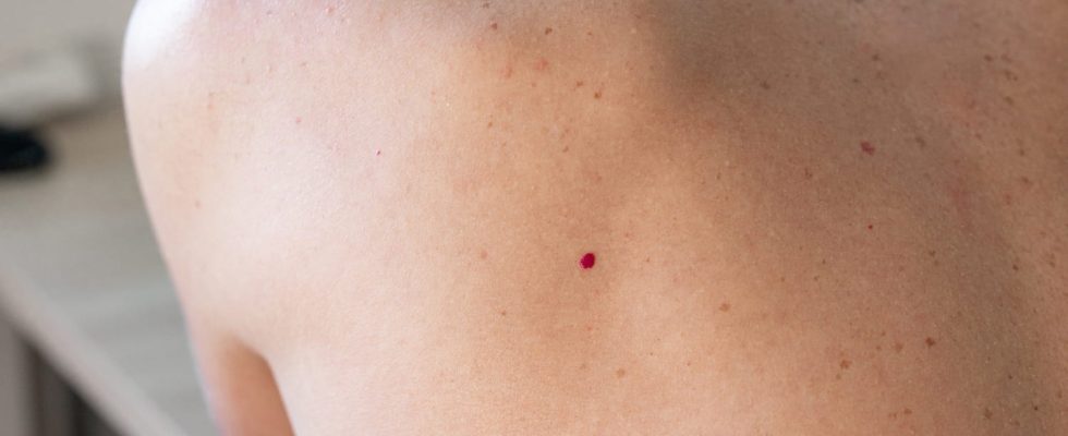 Ruby angioma causes dangerous what is it