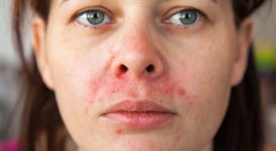 Redness around the mouth perioral dermatitis