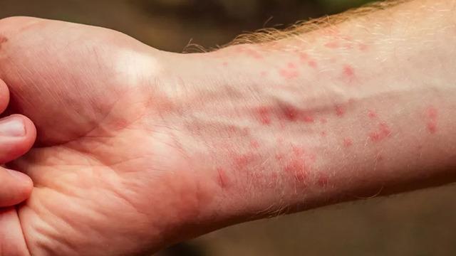 scabies disease 2