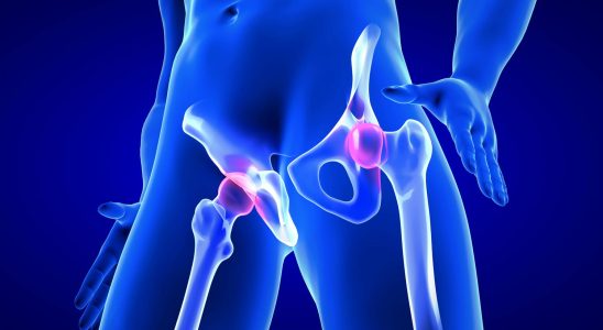 Hip fracture symptoms when to operate