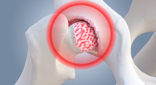 How to treat hip dysplasia