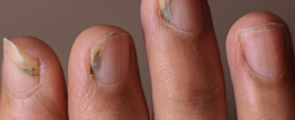 What is green nail syndrome