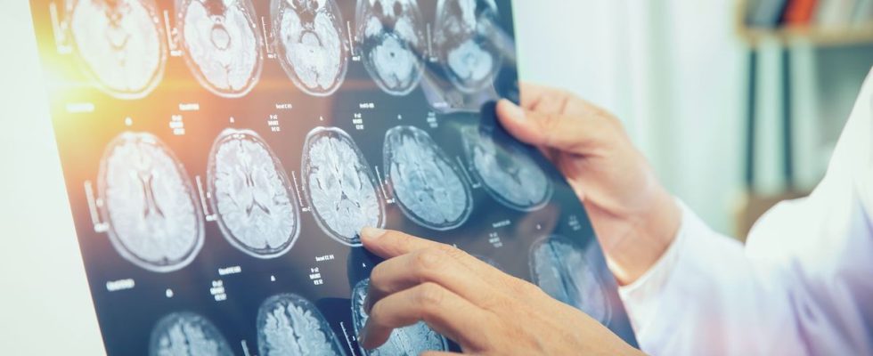 Multiple sclerosis can now be detected earlier and more accurately