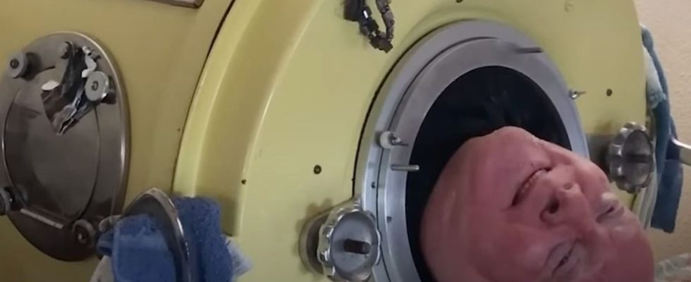 He lived in an iron lung for 72 years discover