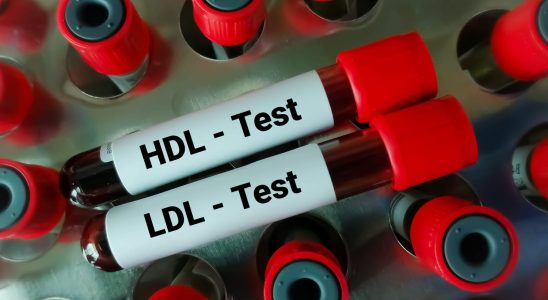 LDL cholesterol low calculation in women what standard