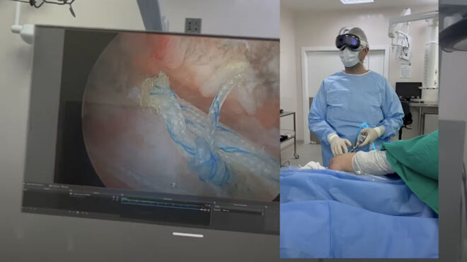 Apple Vision Pro was used in a shoulder surgery this