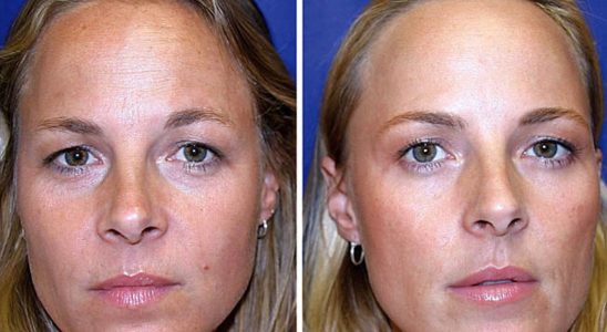 A study on twins reveals the true effects of botox