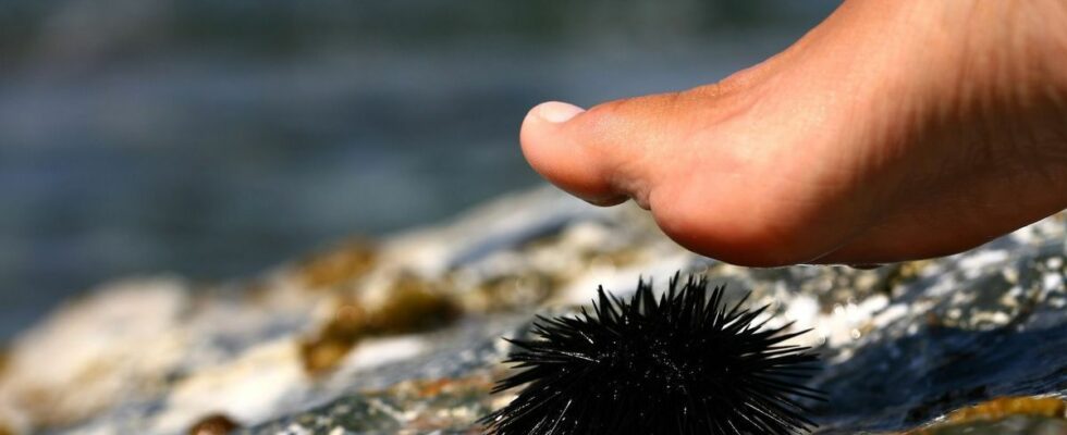 After stepping on a sea urchin he had 3 toes