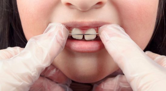 Orthodontics more than one in two French people still do