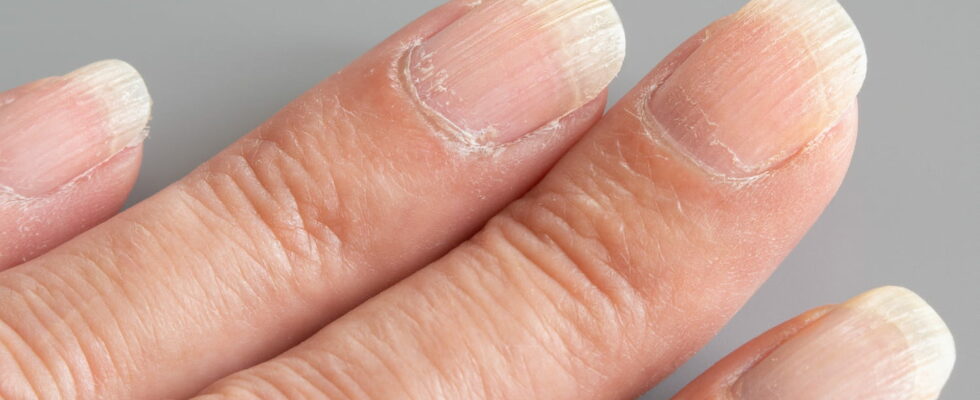 Striated nails this is not normal you need to consult