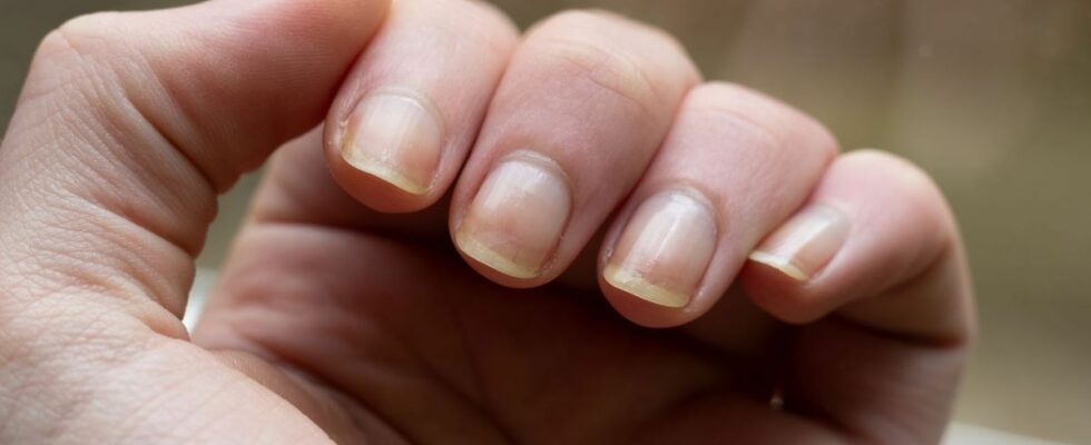 This abnormality on your nails could be a sign of