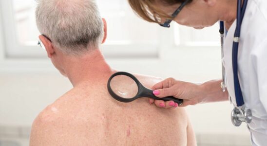 Skin cancers technology and AI for better screening