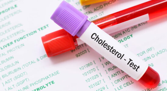 1721195007 Cholesterol level not to be exceeded after 60 years