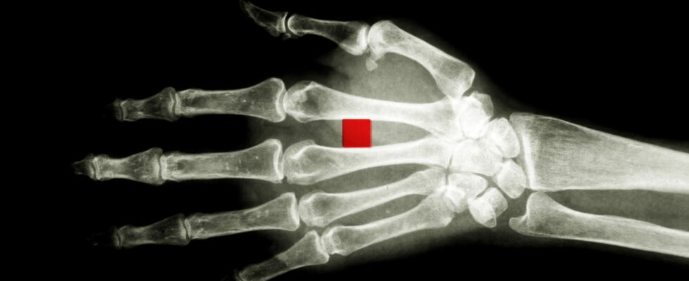 A cybersecurity expert has had a dozen microchips implanted in