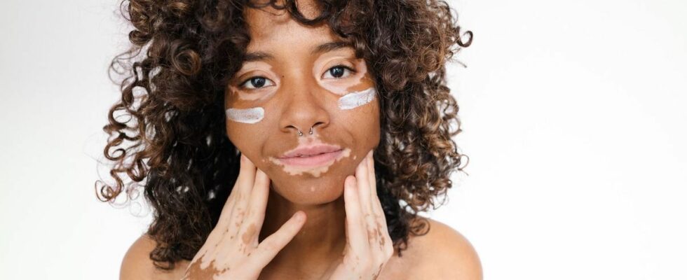 Vitiligo Revolutionary treatment reimbursed available in pharmacies from July 27