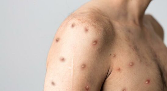 Africa declares emergency Prof Dr Ceyhan warns of monkeypox variant