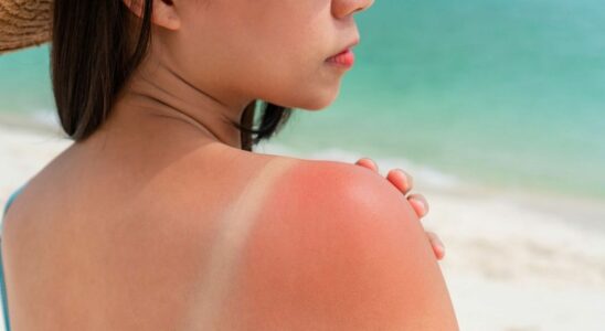 Be careful this type of sunburn increases the risk of