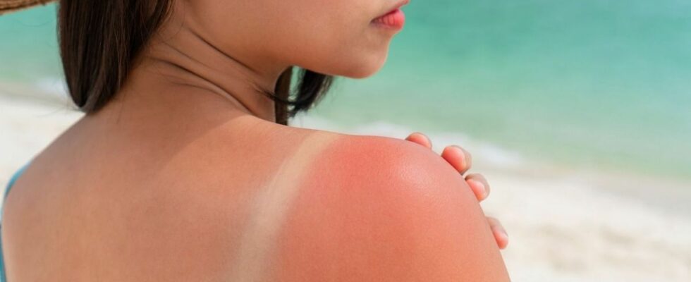 Be careful this type of sunburn increases the risk of