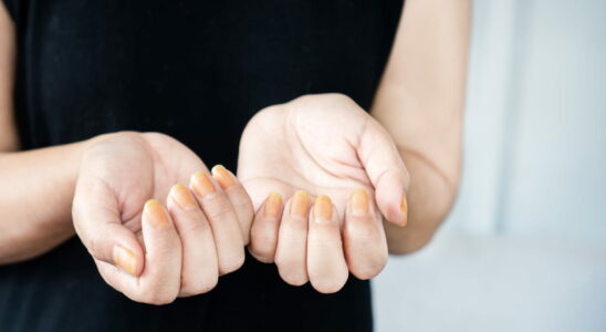 This color under your nails should be a cause for