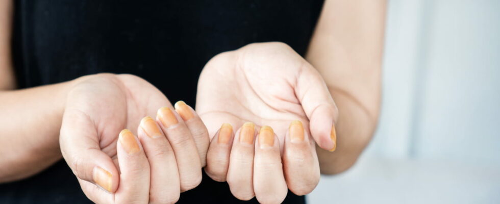 This color under your nails should be a cause for