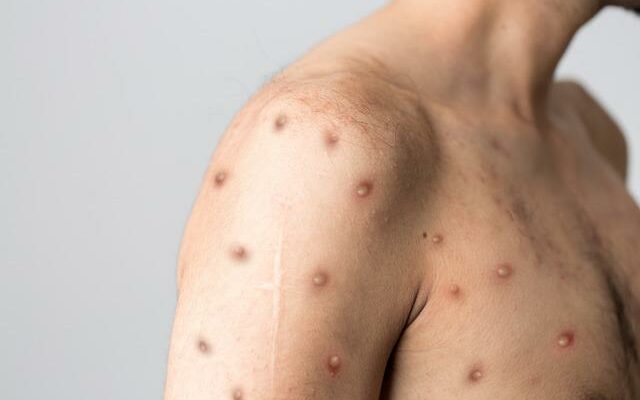 What is monkeypox what are its symptoms How is monkeypox