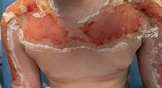 10 year old boy used sunscreen He was taken to hospital Its