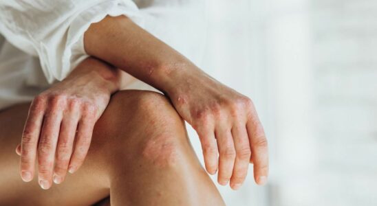 A French discovery could revolutionize the treatment of psoriasis