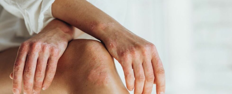 A French discovery could revolutionize the treatment of psoriasis