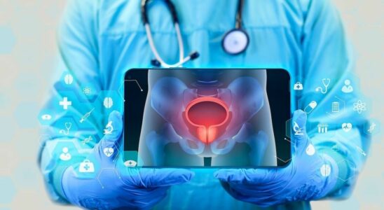 Advanced bladder cancer 32 fewer recurrences and 25 fewer deaths