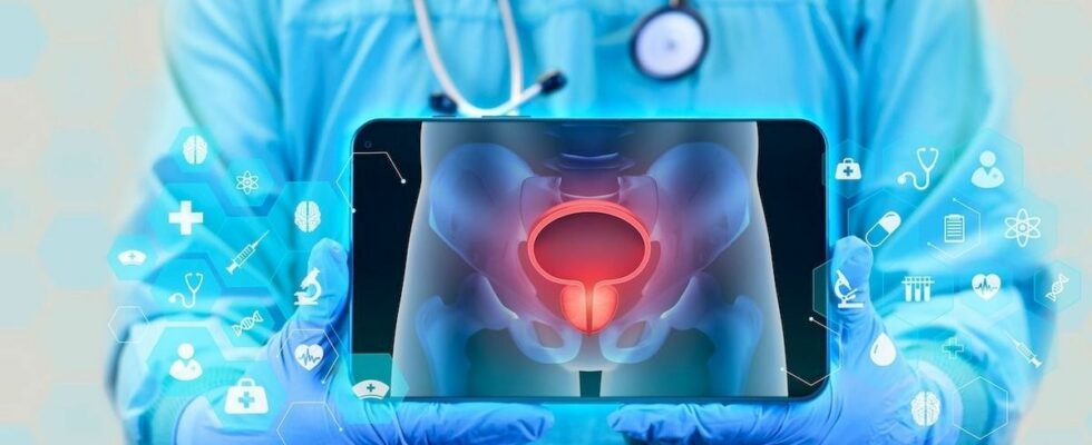 Advanced bladder cancer 32 fewer recurrences and 25 fewer deaths