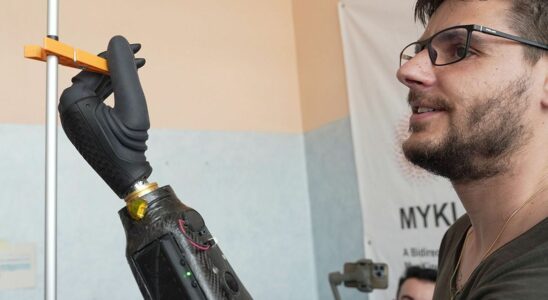 Amputees control bionic hand with thoughts using wireless electrodeless technology