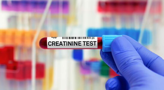 At what creatinine level is dialyzed