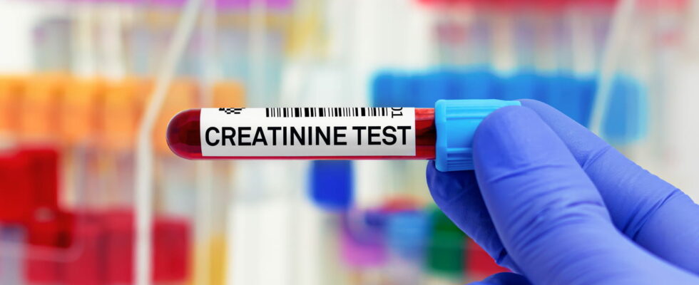 At what creatinine level is dialyzed