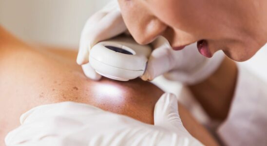 Sweden Skin cancer in young adults decreases a first in