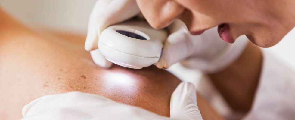 Sweden Skin cancer in young adults decreases a first in